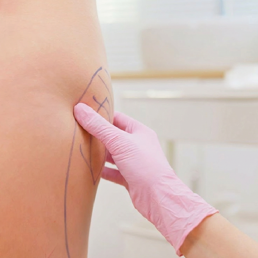 Cell-redutti-tratamento-para-celulite-curitiba-ana-fonseca-capa-pequena